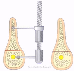 Distractor alveolar + implante