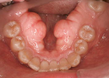 Torus dientes caso 2